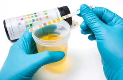 Read more about the article Urine analysis