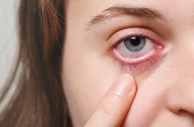 Read more about the article conjunctivitis-causes, symptoms and treatment